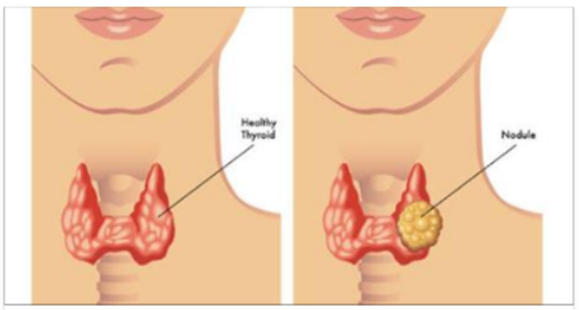 Risultati immagini per tiroide